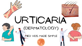 Urticaria  Dermatology Pathophysiologyclinical featuresdiagnosistreatment MedVidsMadeSimple [upl. by Oijres666]