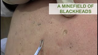 A Minefield of Blackheads  Dr Derm [upl. by Murphy]