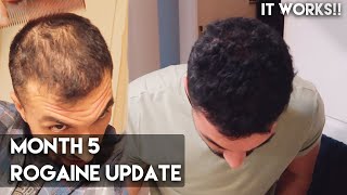 5 Month Rogaine Update Minoxidil  IT WORKS [upl. by Alabaster]