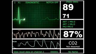 Hospital Monitor with FlatLine L HD [upl. by Eiramyma]