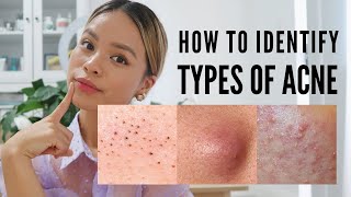 How to treat EVERY type of acne With Pictures [upl. by Adnotal84]