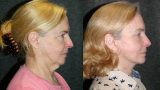 New Facelift Procedure S Lift  Deep Plane Facelift Before and After 65 YO Woman bestnycfacelift [upl. by Singer]