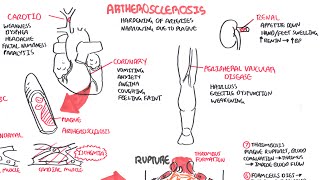 Atherosclerosis  Pathophysiology [upl. by Tavia851]