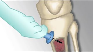 Placement of an Intraosseous Line by MKleinman  OPENPediatrics [upl. by Lorimer]