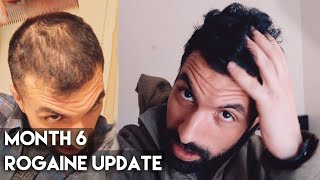 6 Month Rogaine Results Minoxidil [upl. by Acinimod537]