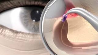 Punctum plug procedure  animation [upl. by Gytle]