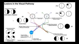 Lesions to the Visual Pathway EXPLAINED [upl. by Konstance111]