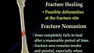 Fracture Healing Part 1  Everything You Need To Know  Dr Nabil Ebraheim [upl. by Anaitit]