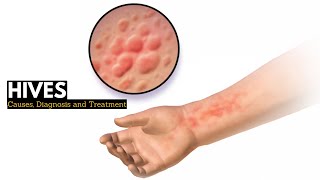 HIVES Causes Signs and Symptoms Diagnosis and Treatment [upl. by Martinsen990]