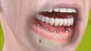 Straumann  Fixed restoration with 46 implants all straight [upl. by Gerhardt893]