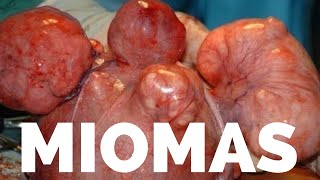 MIOMAS UTERINO [upl. by Adi]