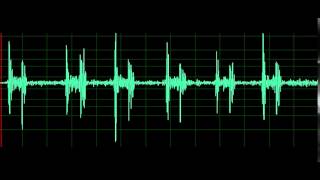 Pulmonary Associated Heart Sounds Tricuspid Regurgitation [upl. by Basile600]