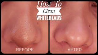 HOW TO REMOVE WHITEHEADS FROM NOSE amp FACE  2019 [upl. by Zysk570]