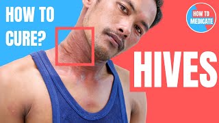 How to treat Hives Urticaria  Doctor Explains [upl. by Finstad268]