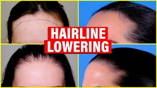 Hairline Lowering Hair Transplant vs Surgical Hairline Advancement [upl. by Moyers525]