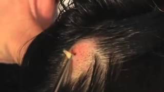 The Botfly in the Head [upl. by Stannwood944]