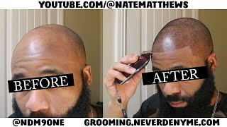 How To Get Your Hairline Back  From Bald To Edge Up  Hairline Restoration [upl. by Ydnab]