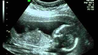 Baby scan at 17 weeks pregnant [upl. by Eadith]