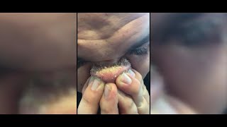 DIY Blackhead Removal Goes Viral [upl. by Lebazej851]