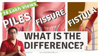 Piles  Fisure  Fistula  Difference explained  Dr Vishal Tomar  Open Consult [upl. by Fahey]