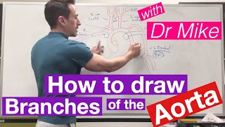 Truncus arteriosus 5 Chamber view [upl. by Aicenet]