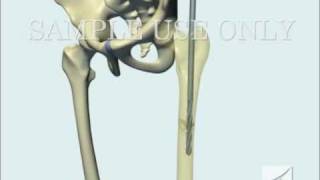 Femoral Fracture Fixation Surgery Intramedullary Nail [upl. by Osborne788]