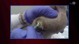 Management of patients with calciphylaxis  Video abstract ID 182417 [upl. by Wilson378]