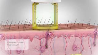 Depilación Laser Cómo actúa en la piel [upl. by Aihsek]