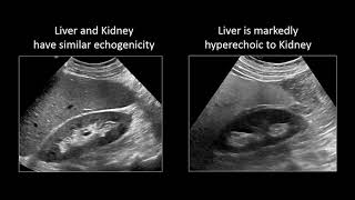 GI Imaging  Hepatic Steatosis and Cirrhosis [upl. by Jabin925]