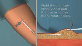 Jadelle insertion and removal Tutorial [upl. by Bowerman]