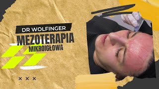 Dermapen  mezoterapia mikroigłowa [upl. by Findlay]