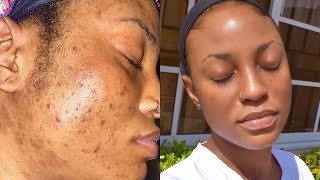 SKINCARE ROUTINE FOR OILY ACNE PRONE SENSITIVE SKIN  How I deal with Hyper Pigmentation amp Texture [upl. by Oelc]