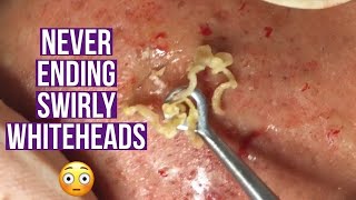 Blackhead and whitehead extractions relaxing amp satisfying [upl. by Byrann]