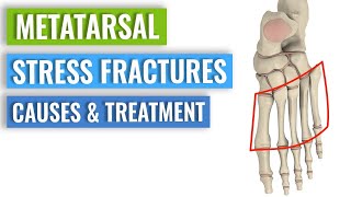 Metatarsal Stress Fractures  Causes Treatment Prevention [upl. by Hoagland424]