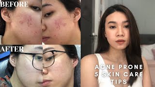 5 Skin Care Tips For Acne ProneOilySensitive Skin  Andy Buela Philippines [upl. by Diarmid942]