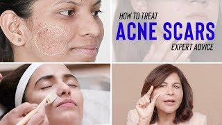 Treatments for ACNE SCARS  Dr Bindus Expert Advice [upl. by Yecad463]