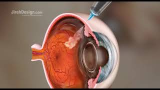 Intravitreal Injection Animation HD [upl. by Ahearn681]