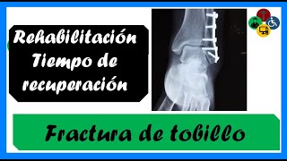 Fractura de TOBILLO  Fractura de TIBIA Y PERONÉ Tiempo de recuperación [upl. by Launam992]