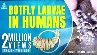 botfly larvae in humans [upl. by Eibmab763]