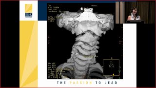 Atlantoaxial C1 C2 Subluxation in the Pediatric Population [upl. by Shaylynn342]