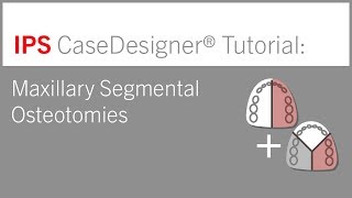 Pedicle Subtraction Osteotomy Procedural Solutions [upl. by Payton]