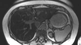 Hepatic Steatosis [upl. by Cohleen]