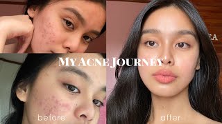 How I Cleared my Acne somehow PHILIPPINES  Lj Torres [upl. by Meredithe]