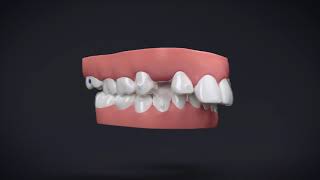 Invisalign® Treatment with Manidublar Advancement [upl. by Ehsiom]