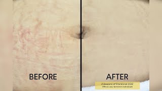 Pregnancy Stretch Marks Removal Treatment in Delhi  Care Well Medical Centre [upl. by Greeley540]