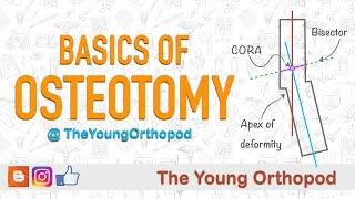 High Tibial Osteotomy  Dr Douglas Wyland [upl. by Anuahsar47]