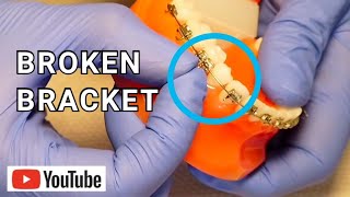 Broken Braces Broken Loose or Sliding Bracket What To Do [upl. by Madian590]