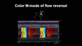 Echocardiography Essentials Detecting aortic regurgitation [upl. by Zahara884]