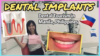 DENTAL IMPLANTS COST PROCEDURE BEFORE AND AFTER  MANILA PHILIPPINES  DENTAL TOURISM English Sub [upl. by Lentha]