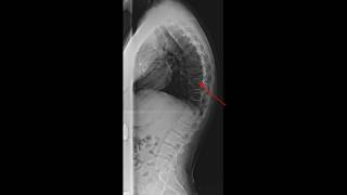 Scheuermanns Disease [upl. by Orsa]